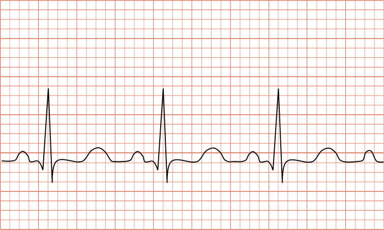 Increased heart rate
