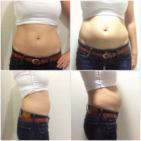 The image above shows a normal stomach on the left and a bloated stomach on the right.