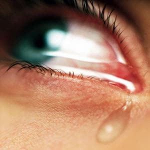 An image example of watery eyes.