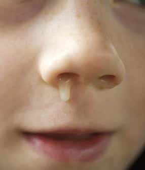 An image which depicts a child with a runny nose.