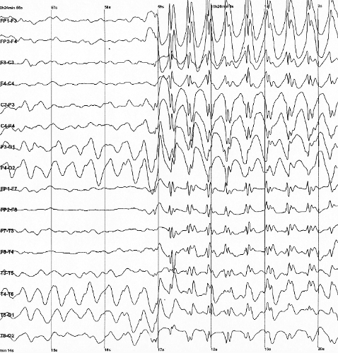 Generalized 3 Hz spike and wave discharges in EEG during a seizure