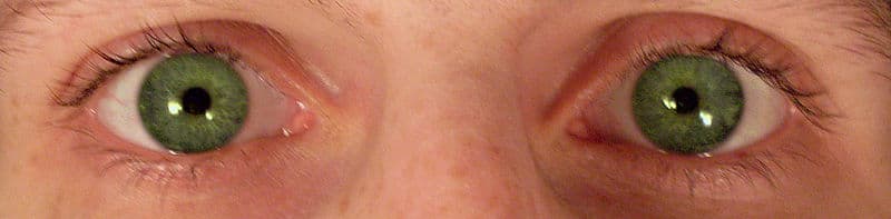 Constricted pupils
